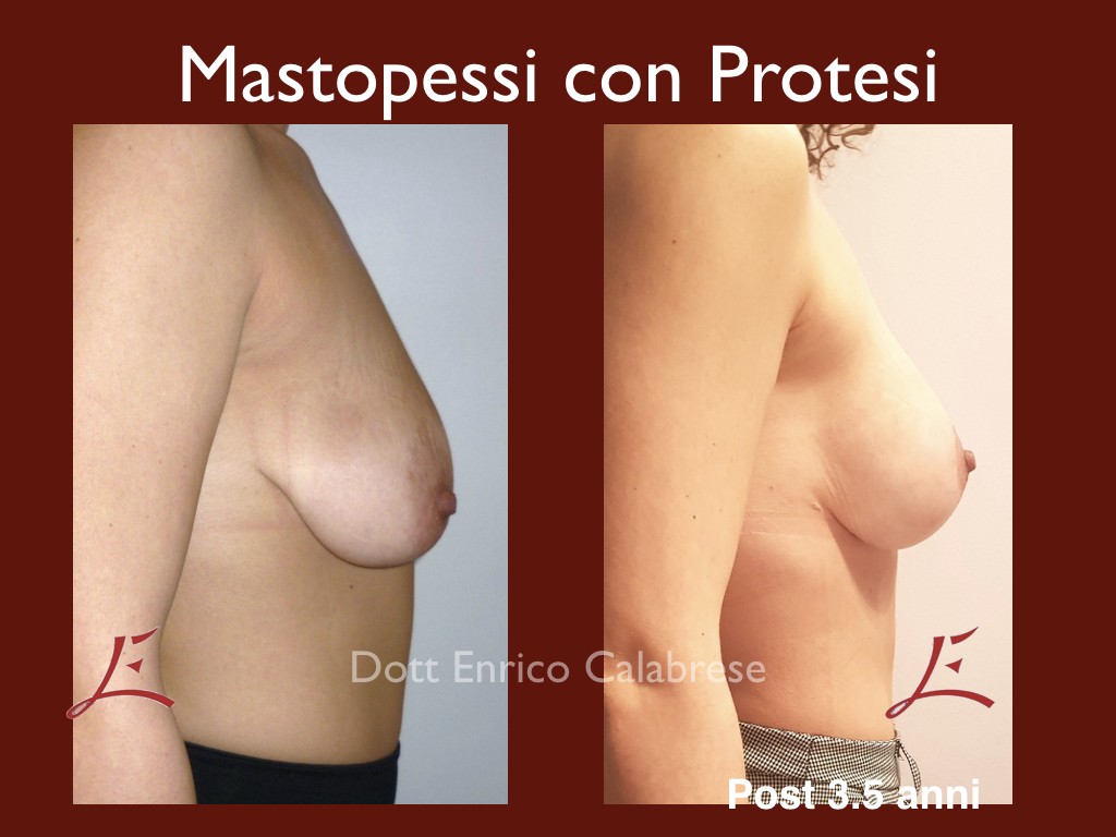 Foto Mastopessi con Protesi