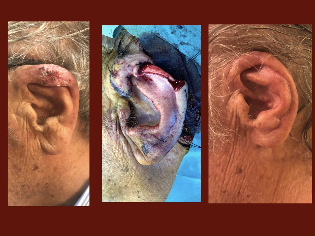 Asportazione Tumore orecchio