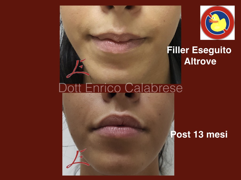 Filler Labbra Durata